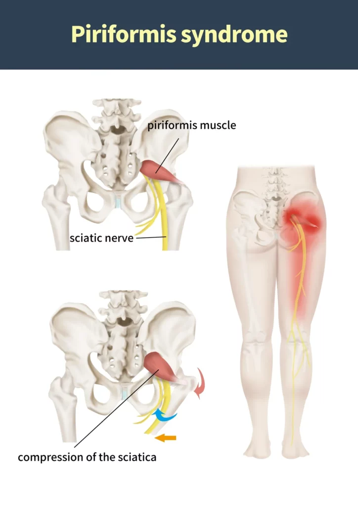 piriformis syndrome.