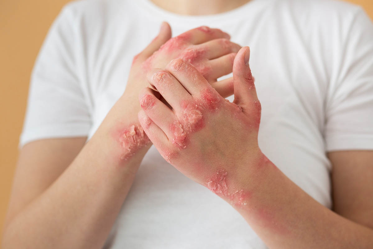 Inflammation of the skin? What are the Causes & Treatment