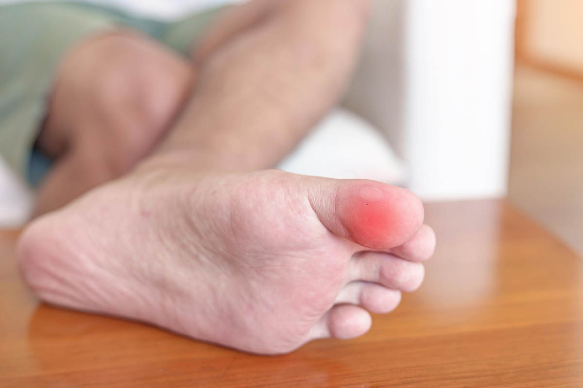 Inflammation in hands, feet, and toes